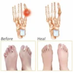 Pack Of_3 Silicone Gel Half Toe Sleeve Anti-Skid Forefoot Smooth And Soft Pads (Color: Assorted)
