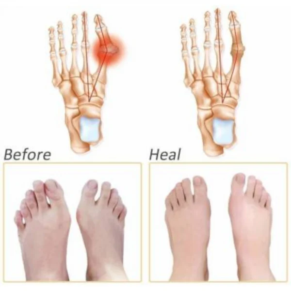 Pack Of_3 Silicone Gel Half Toe Sleeve Anti-Skid Forefoot Smooth And Soft Pads (Color: Assorted)